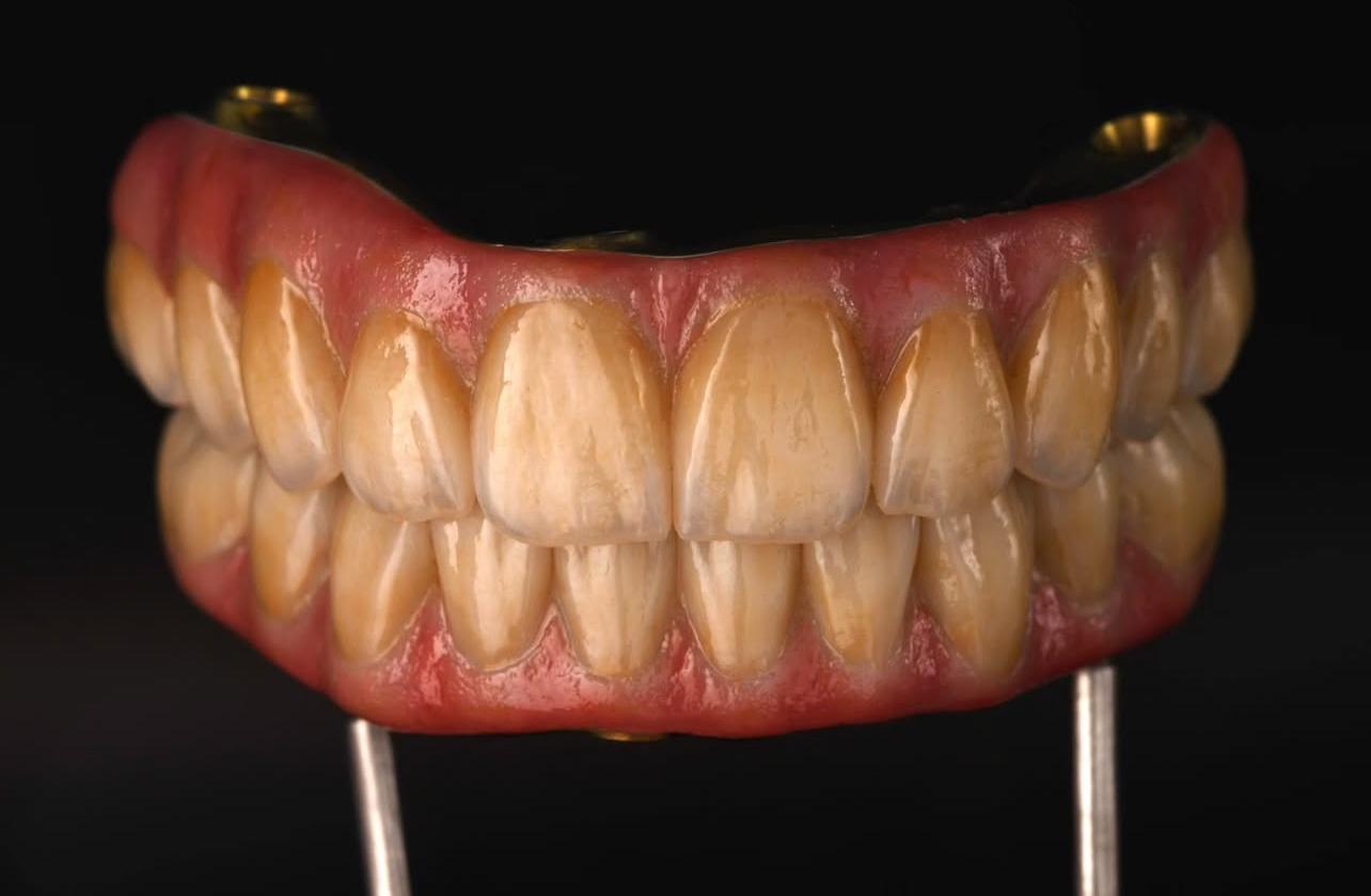 Full-Arch Rehabilitation